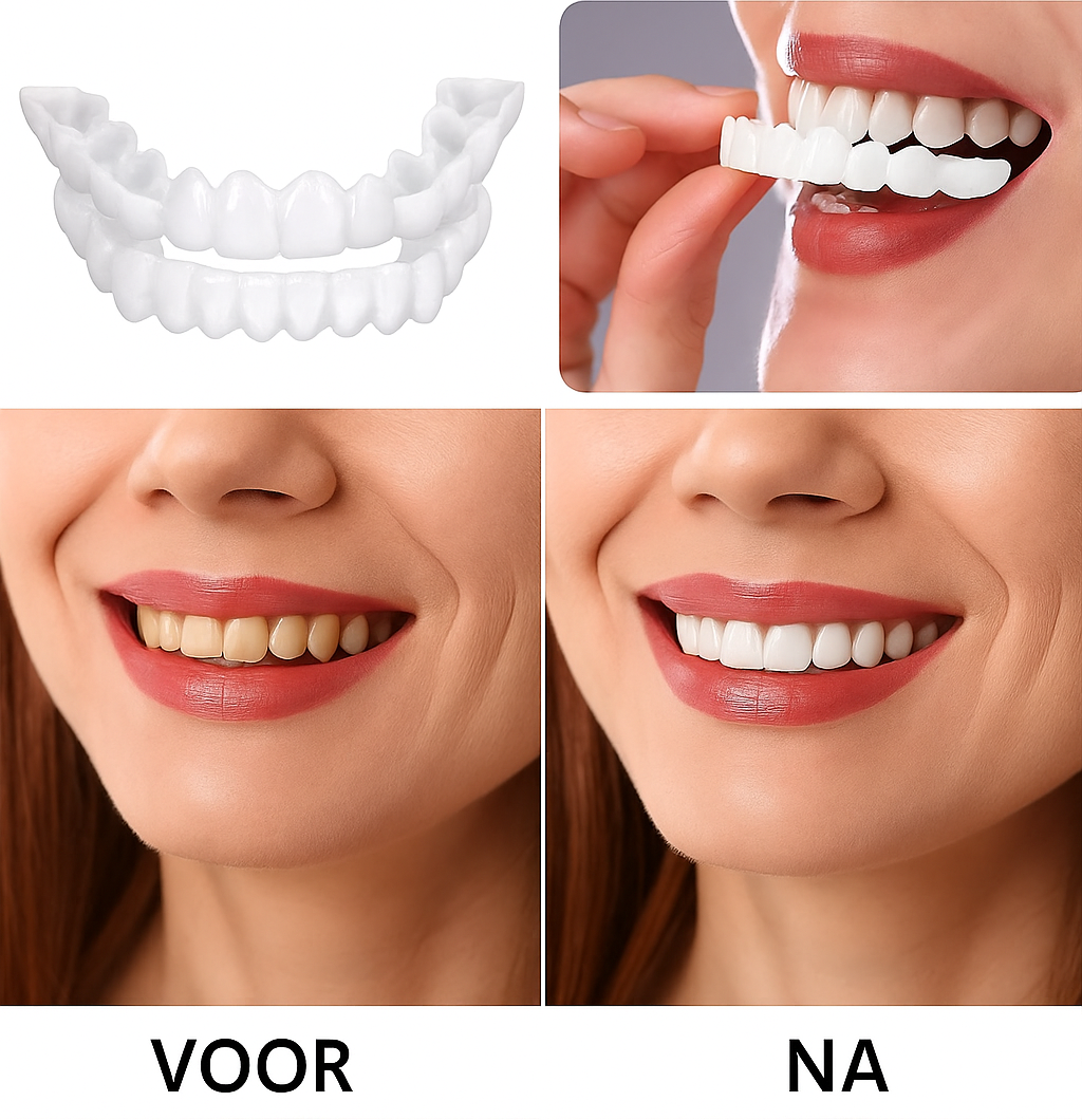 GebitVeneer - De perfecte glimlach